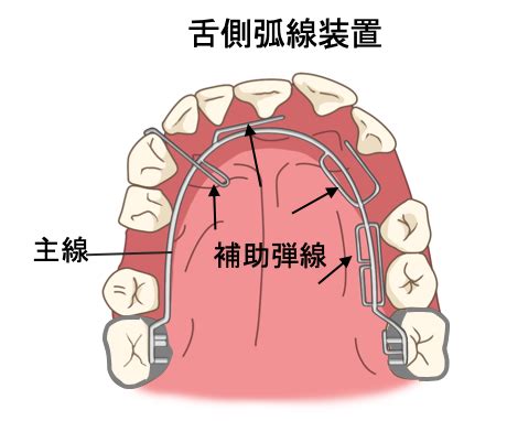 方形矯正線作用